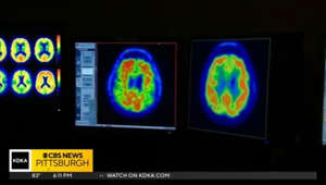 University of Pittsburgh study could open opportunity for earlier detection of Alzheimer's disease