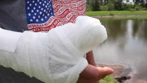 Pasco County man infected with "flesh-eating" bacteria through his thumb