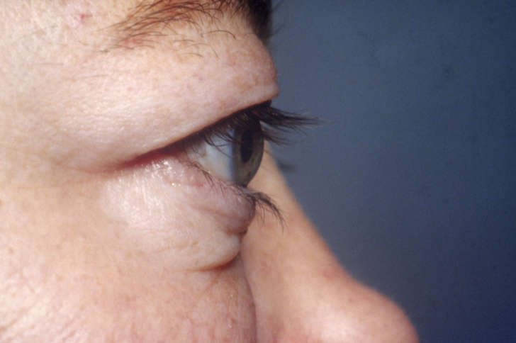 An abnormal protrusion of the eyeball from the eye socket/orbit, which can be associated with Graves' disease.