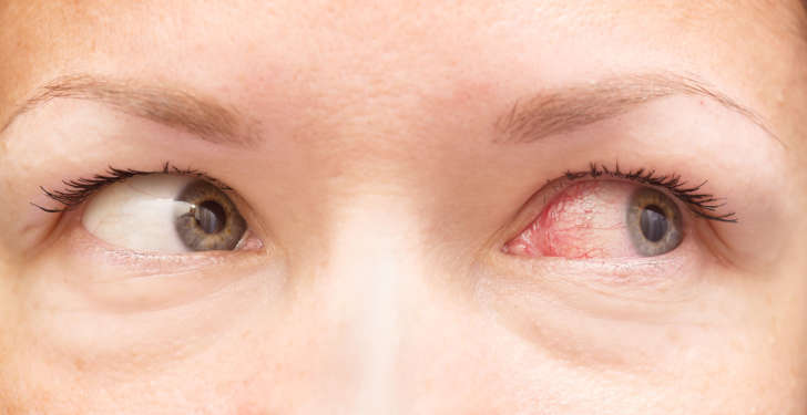 Woman with irritated eye