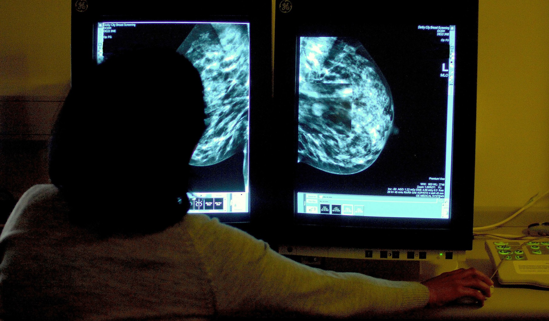 breast cancer symptom that's often