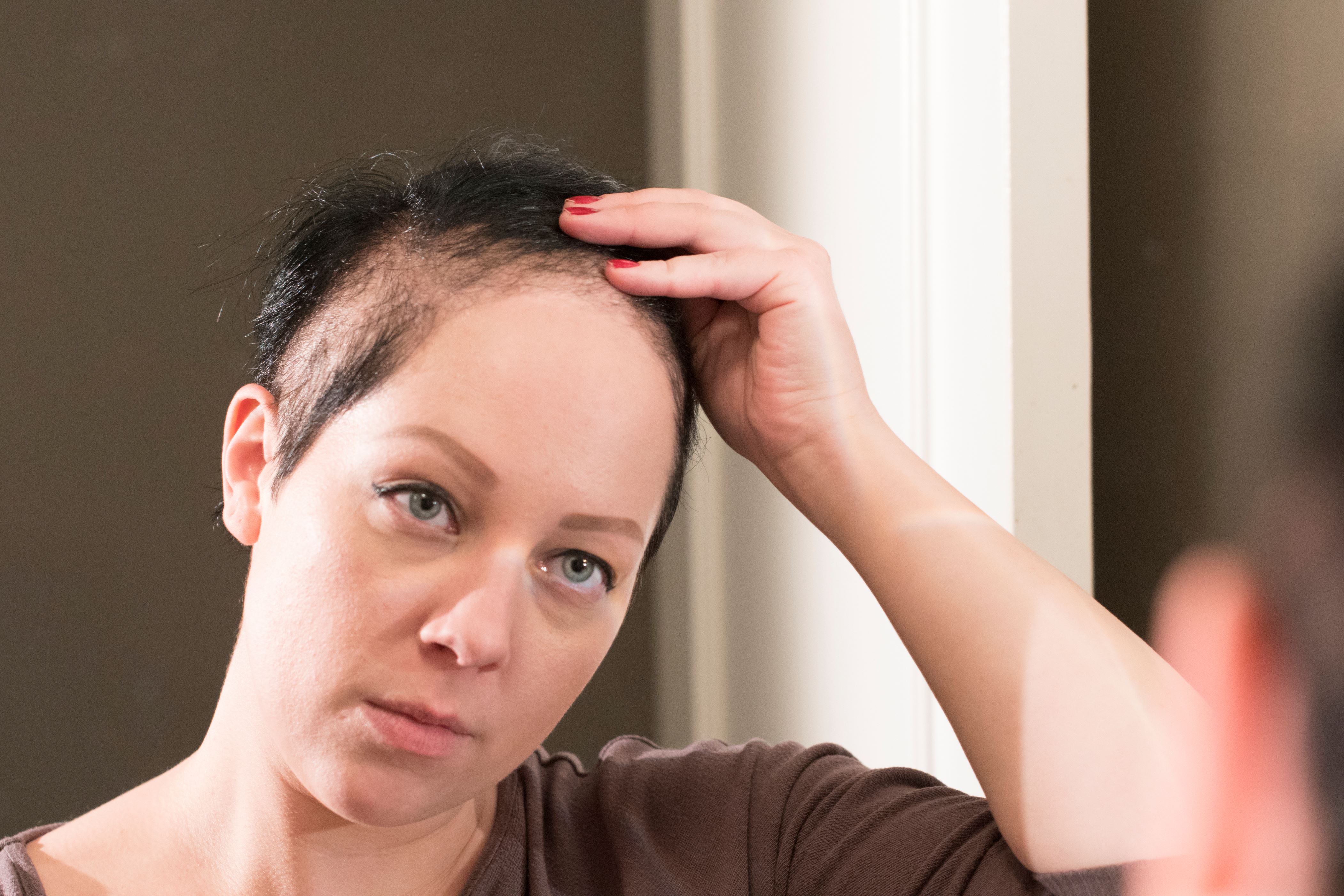 Hair loss: does happen, stopped?