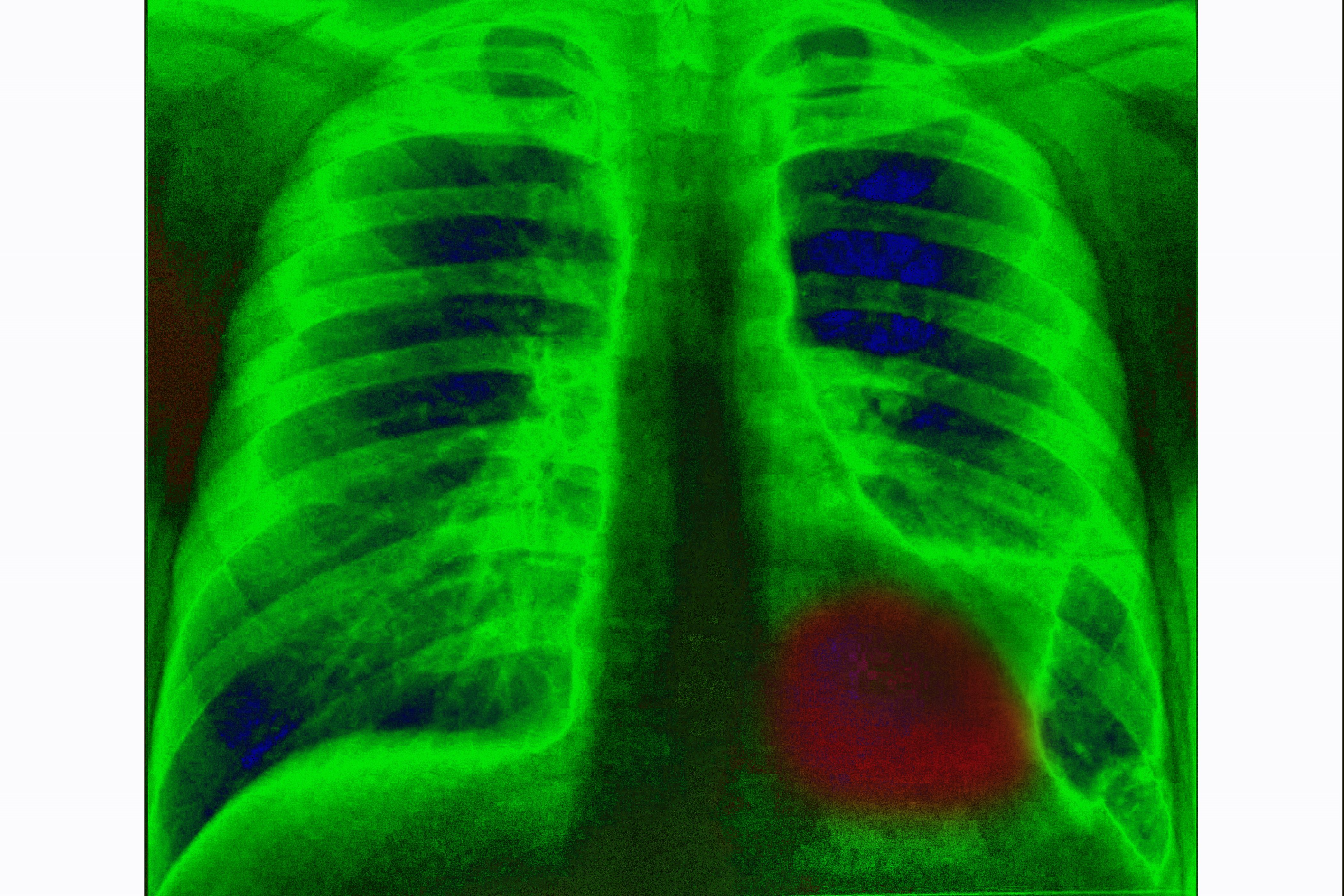 Find your risk lung cancer