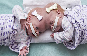 Twin girls conjoined head successfully