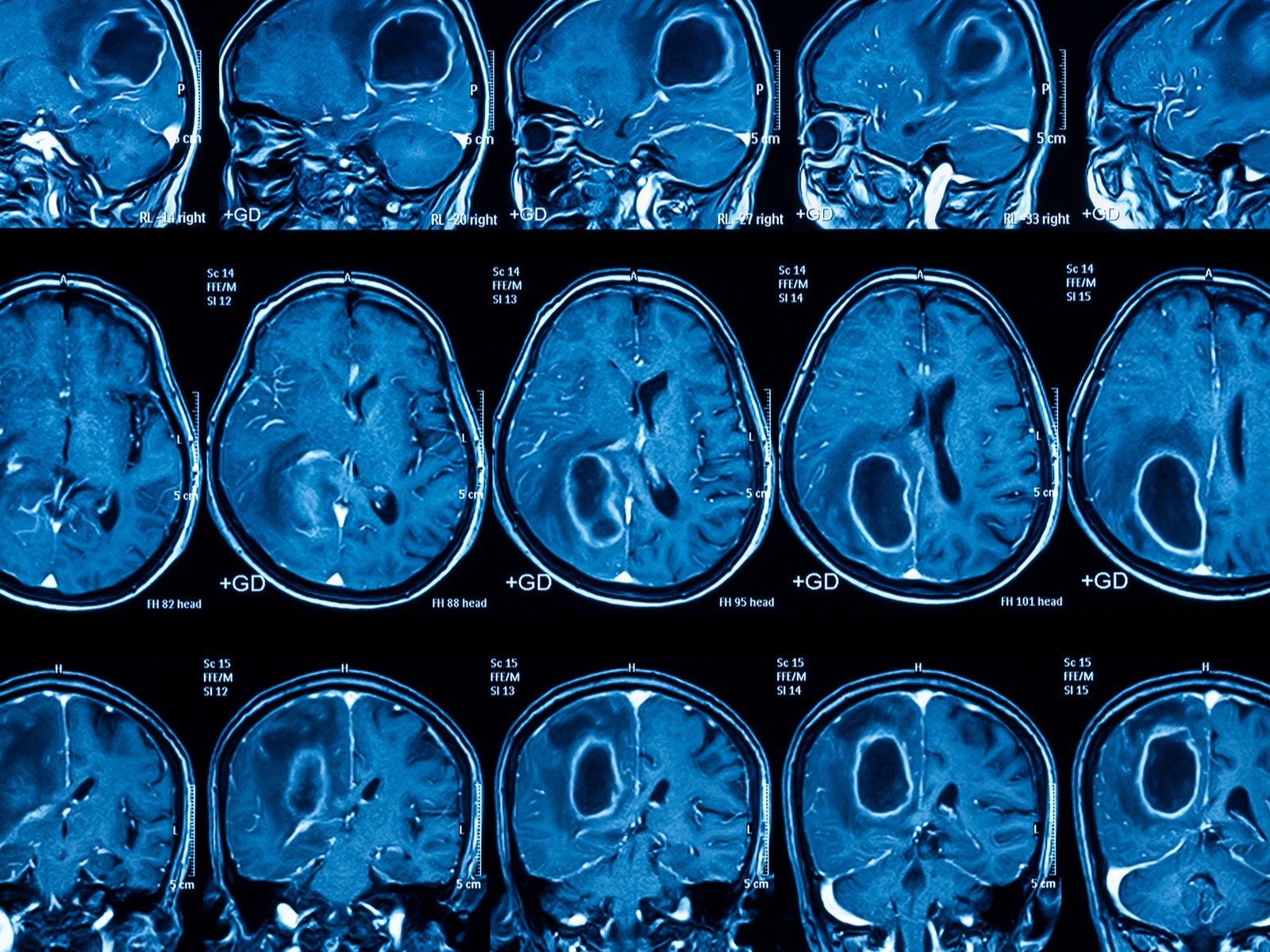 Brain Cancer: What should k**w