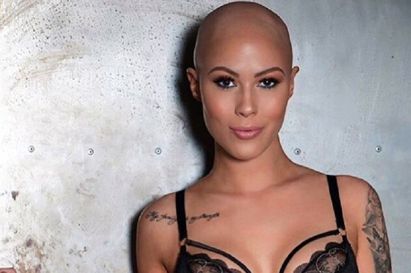 Woman struggled accept alopecia model
