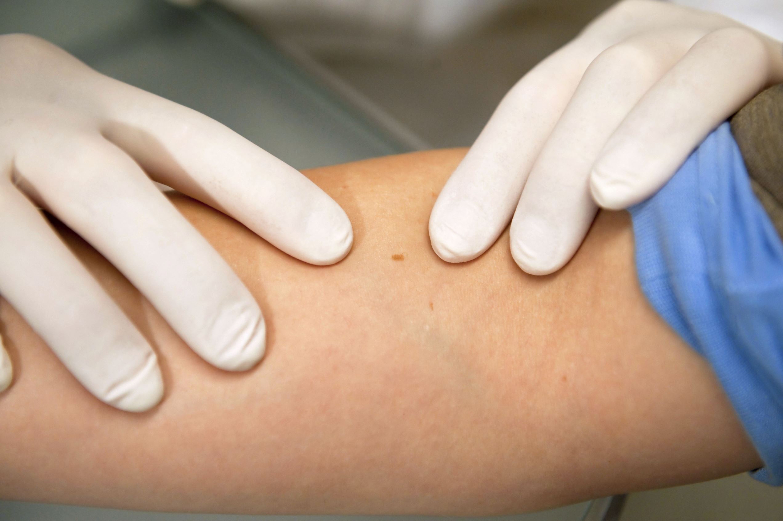 Διαφάνεια 9 από 15: Check if you have a skin allergy