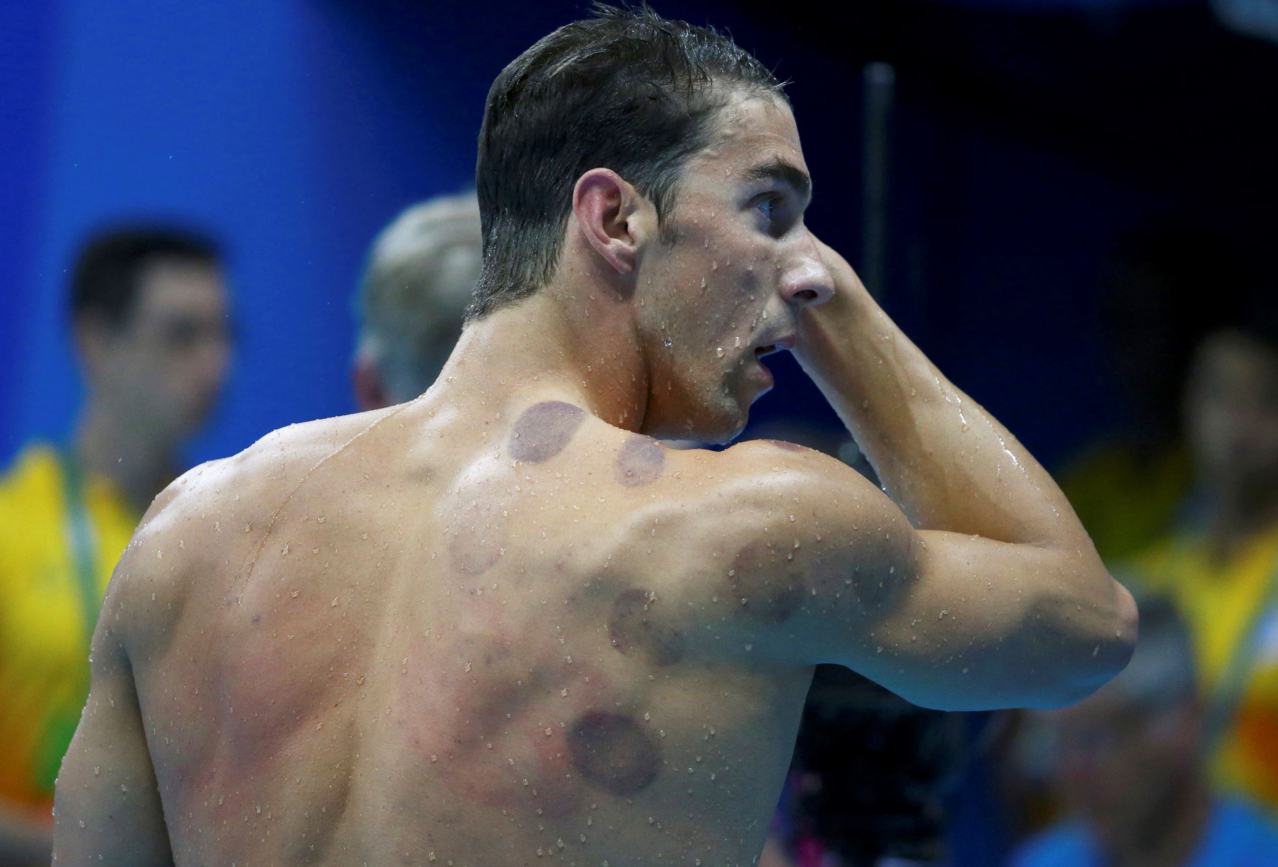What 'cupping' does really athletes