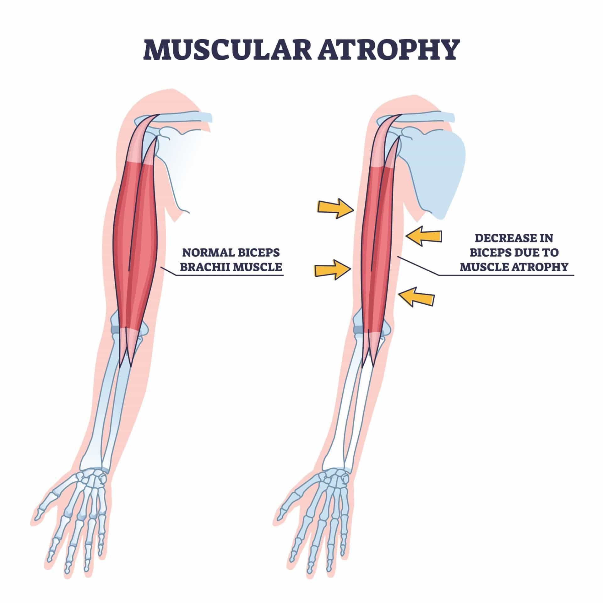 The devastating effects of spinal muscular atrophy