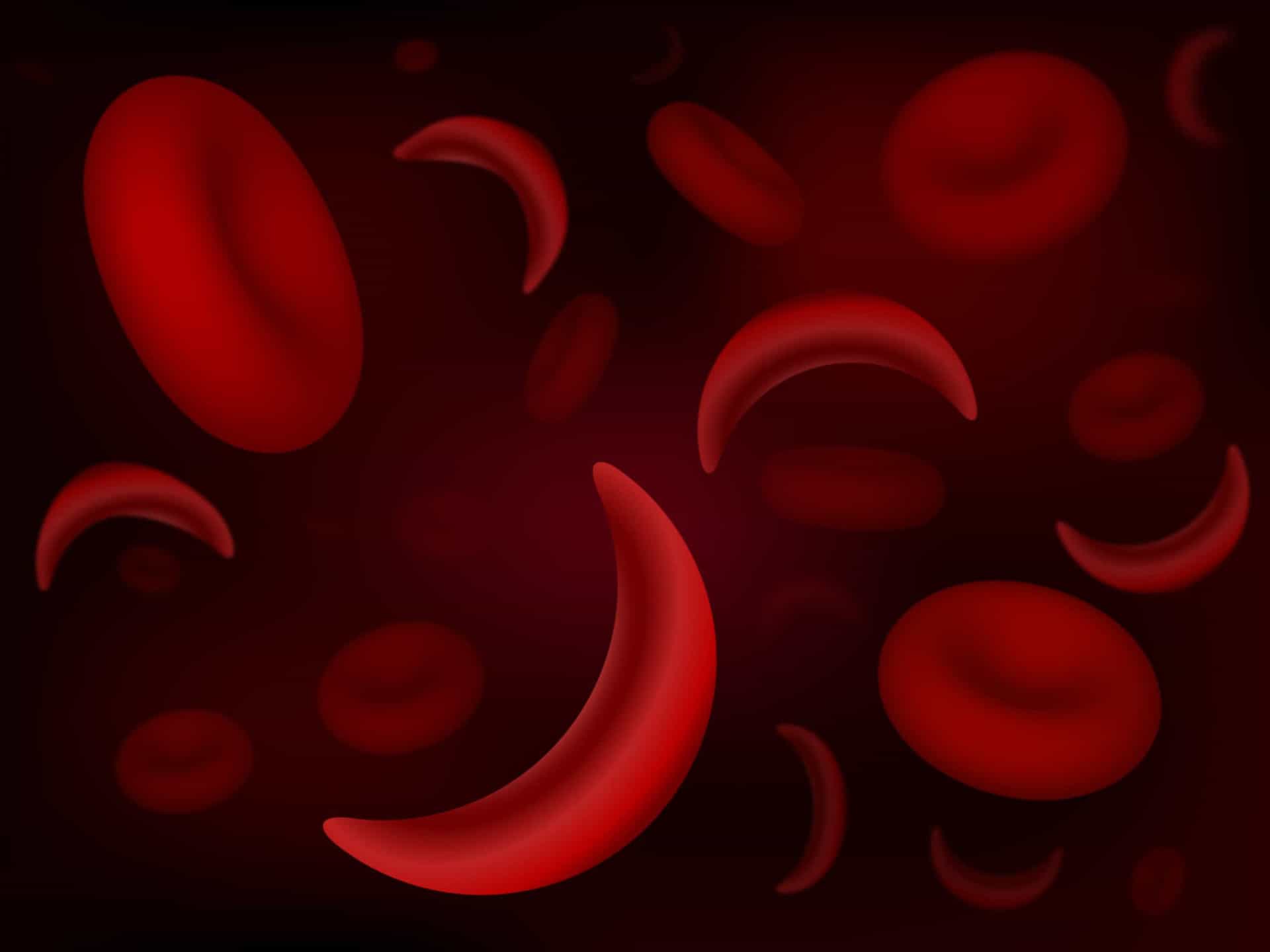 <p>Sickle cells simply gain their name from their shape. As opposed to the round, globulous figure of healthy red blood cells, sickle cells take on a crescent shape, like that of a, you guessed it, sickle.</p><p><a href="https://www.msn.com/en-us/community/channel/vid-7xx8mnucu55yw63we9va2gwr7uihbxwc68fxqp25x6tg4ftibpra?cvid=94631541bc0f4f89bfd59158d696ad7e">Follow us and access great exclusive content everyday</a></p>