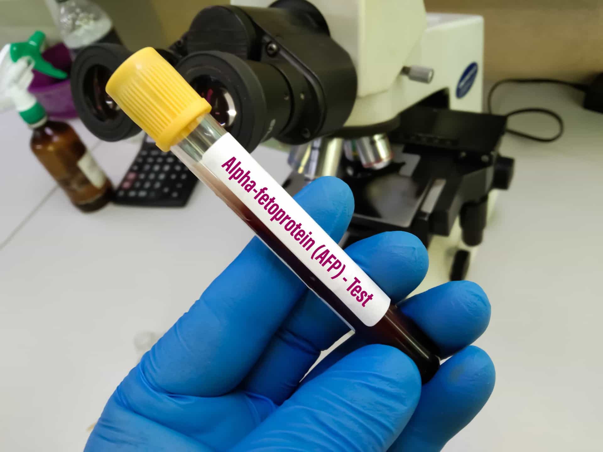 <p>There are two tests sometimes used to detect liver cancer. One is the alpha-fetoprotein blood test, and the other one is an ultrasound of the liver.</p><p><a href="https://www.msn.com/en-us/community/channel/vid-7xx8mnucu55yw63we9va2gwr7uihbxwc68fxqp25x6tg4ftibpra?cvid=94631541bc0f4f89bfd59158d696ad7e">Follow us and access great exclusive content everyday</a></p>