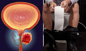 Prostate cancer: 'Warning' sensations that appear on the toilet include pain when peeing.