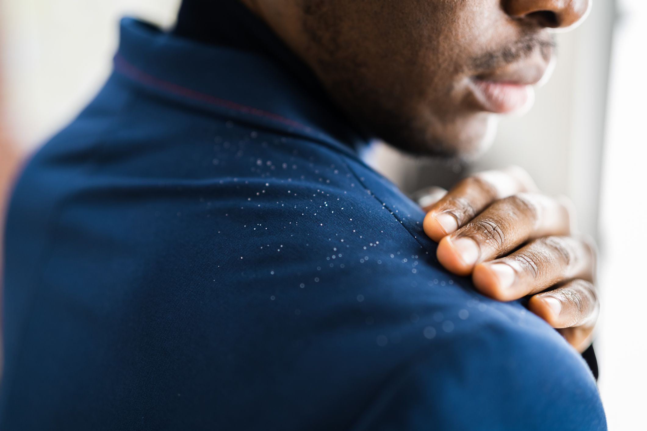 <p>Dandruff and seborrheic dermatitis <a href="https://www.ncbi.nlm.nih.gov/pmc/articles/PMC4852869/">typically affect</a> infants, teens going through puberty and those in mid-adulthood. They present as dry, itchy, flaking skin because they affect the oil-producing areas of the body.</p><p><a href="https://www.ncbi.nlm.nih.gov/pmc/articles/PMC4852869/">These symptoms</a> again can indicate low zinc or niacin levels, or possibly low riboflavin (B2) and pyridoxine (B6). To <a href="https://ods.od.nih.gov/factsheets/Thiamin-HealthProfessional/">increase your levels</a> of these nutrients, try eating whole grains, poultry, meat, fish, eggs, dairy or starchy vegetables.</p>