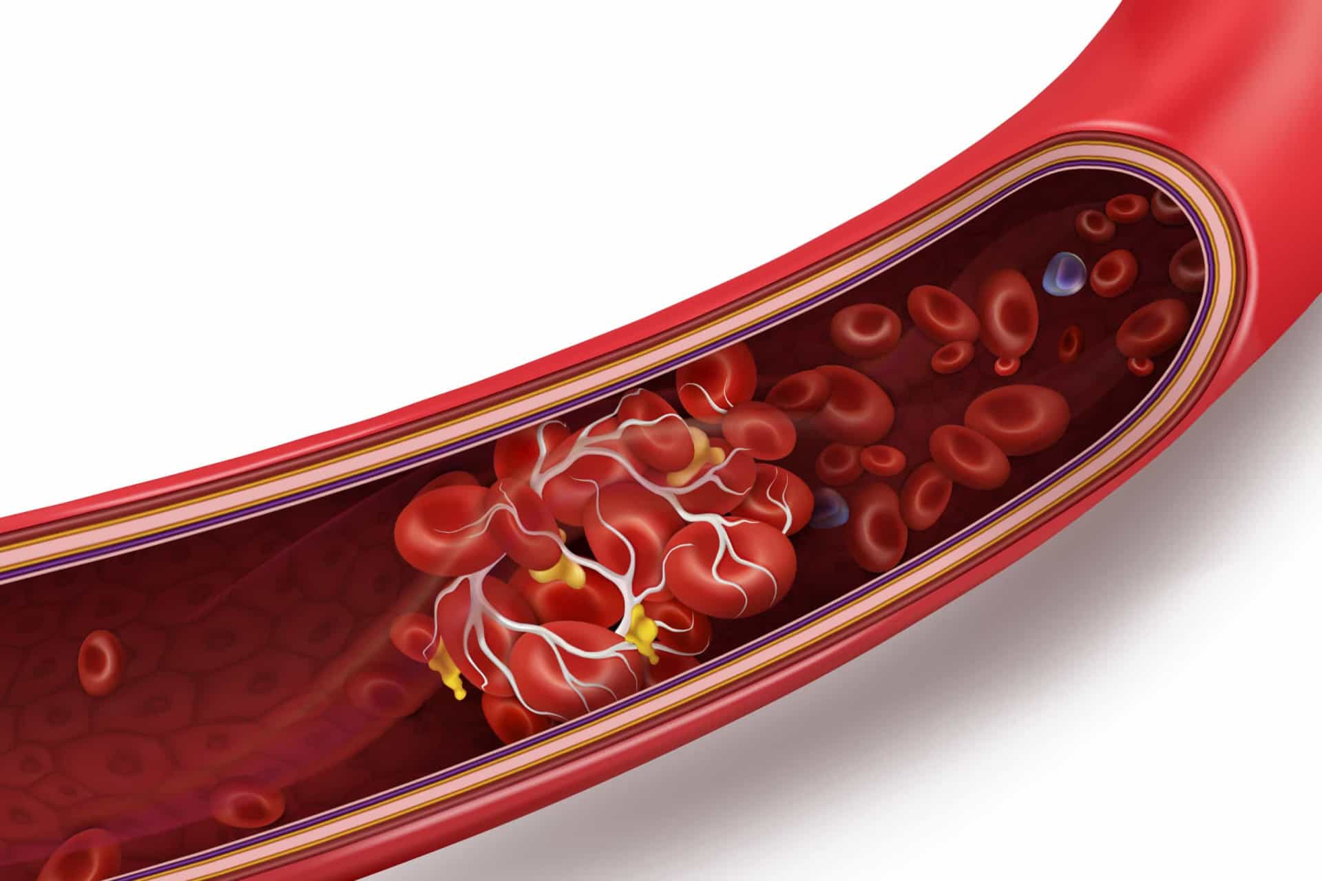 <p>Venous thromboembolism (VTE) is when your blood clots in a deep vein. Research shows that people with types A, B, or AB blood are at a higher risk of VTE.</p><p>You may also like:<a href="https://www.starsinsider.com/n/480097?utm_source=msn.com&utm_medium=display&utm_campaign=referral_description&utm_content=516686en-us"> The unbelievably dramatic life of Princess Alice</a></p>