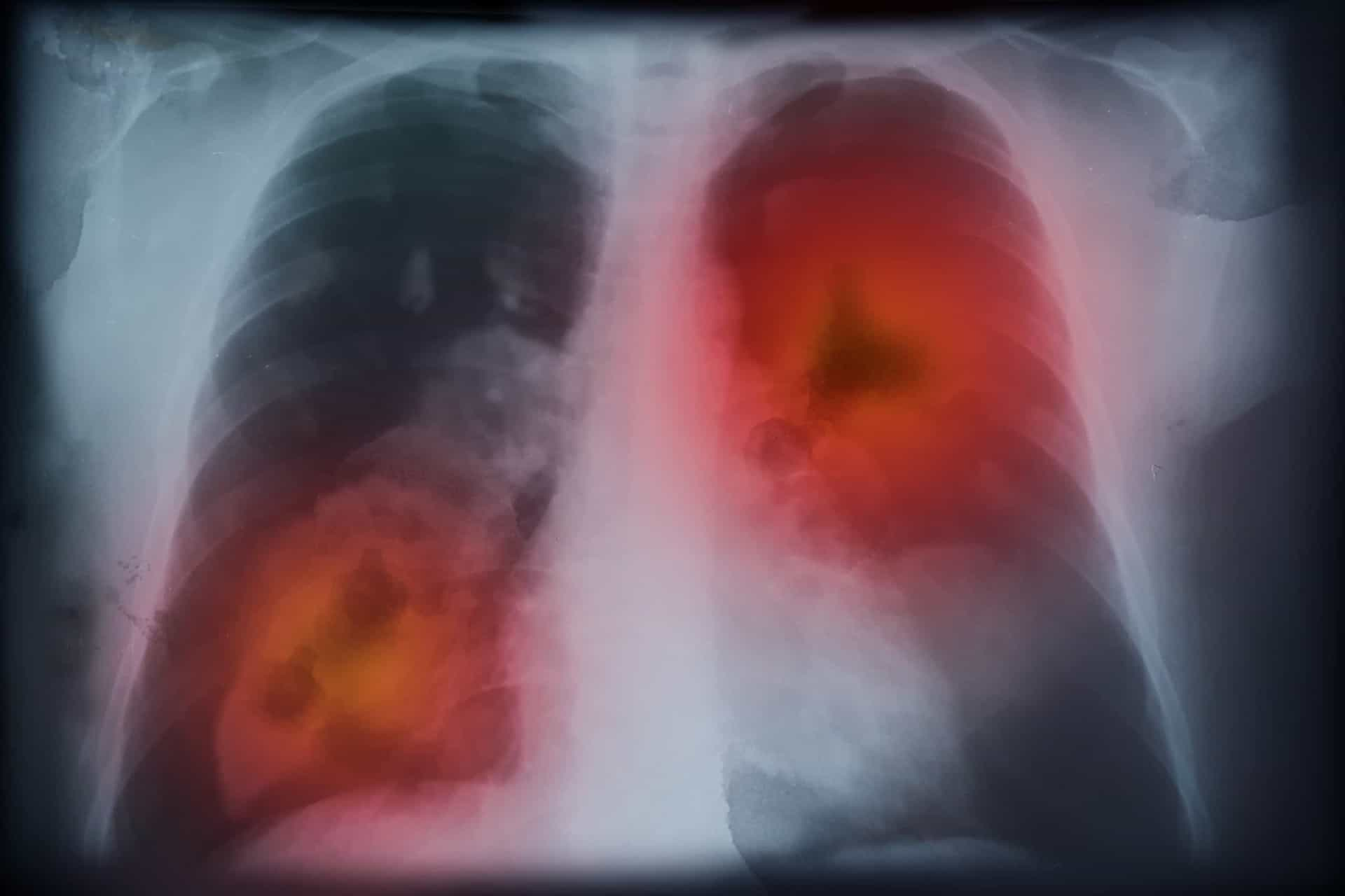 Everything you need to know about lung cancer