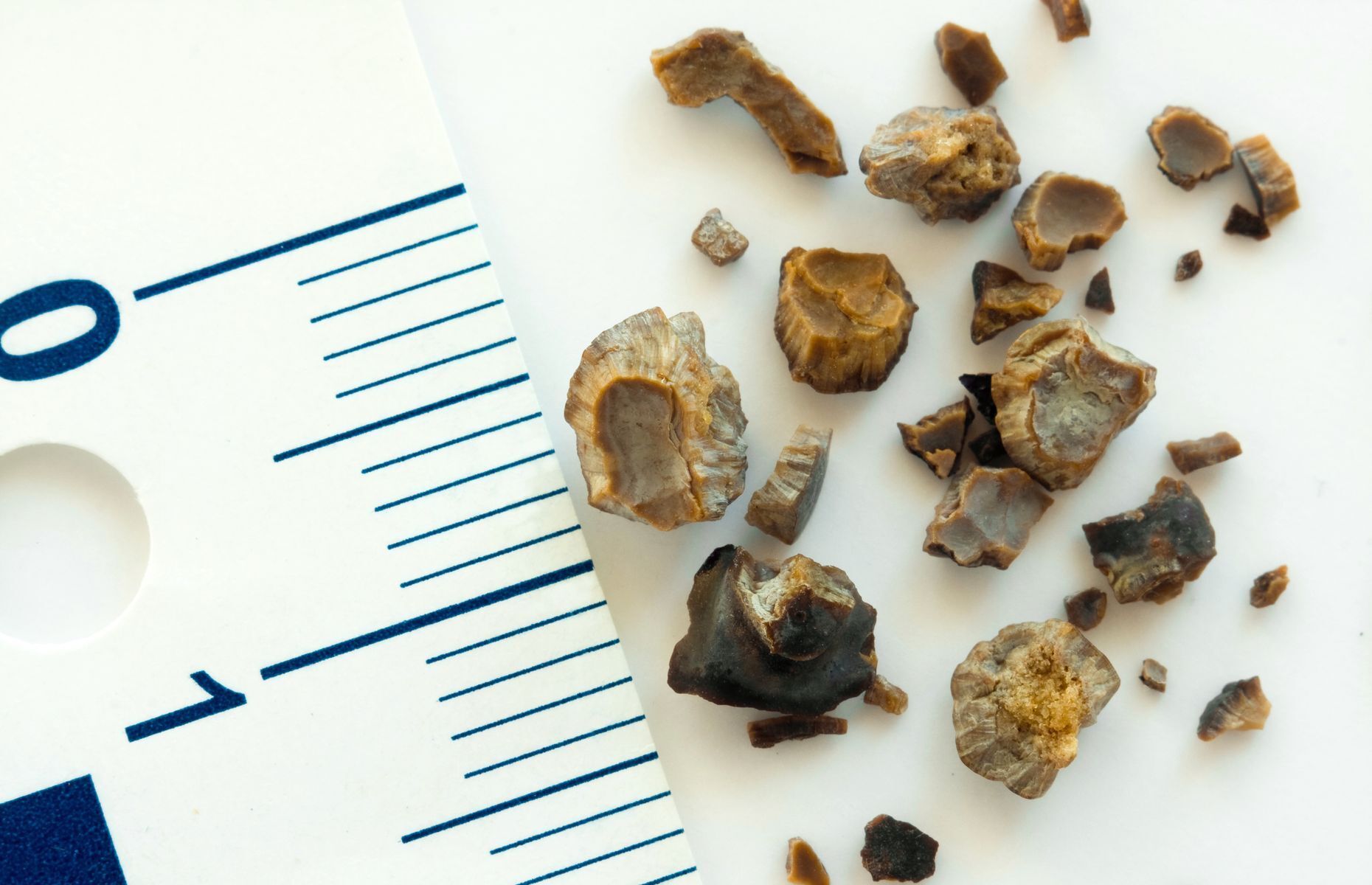 Kidney stones: symptoms, treatments and prevention