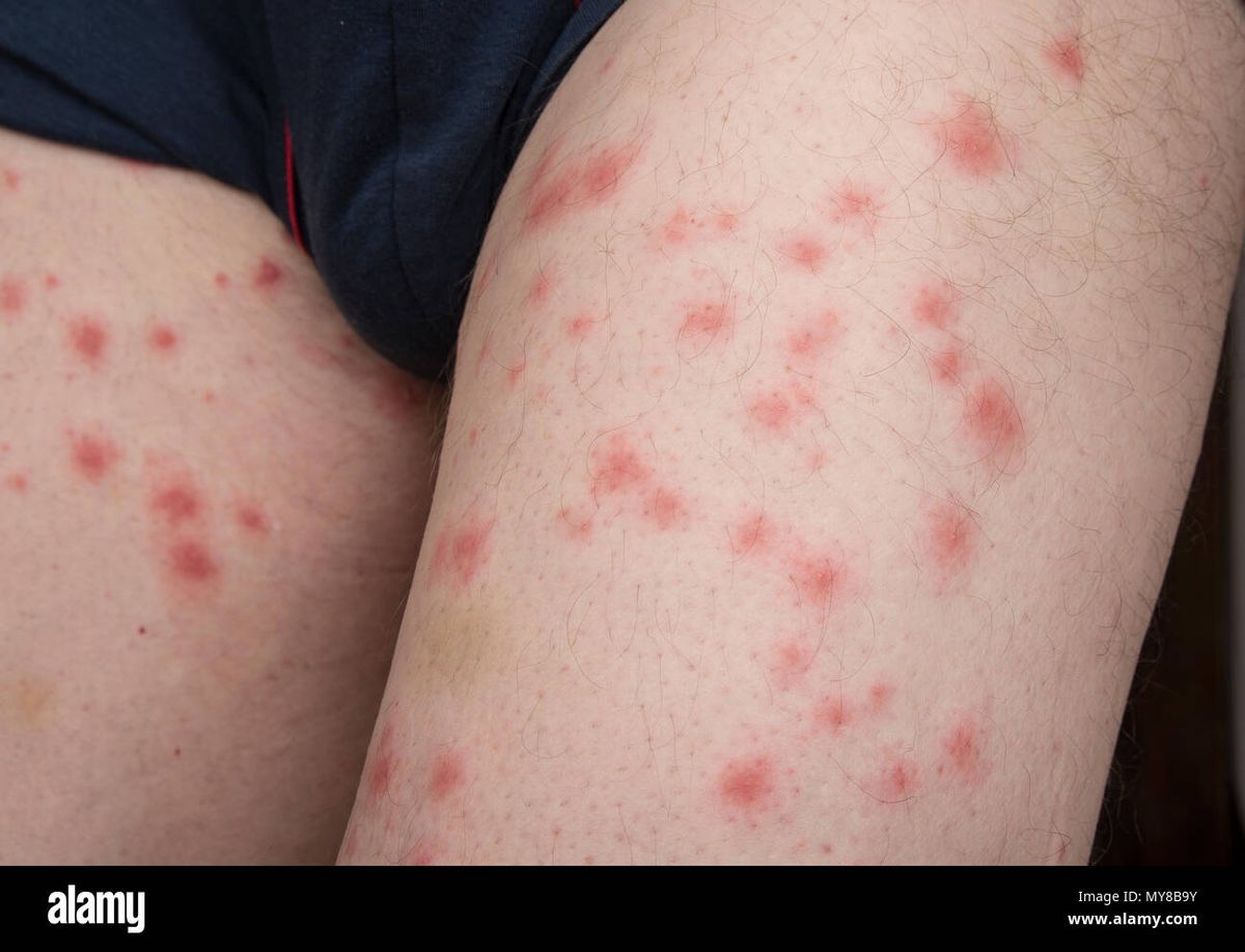 These Pictures Will Help You Identify the Most Common Skin Rashes