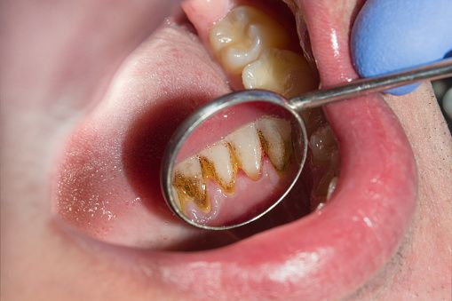 remedios caseros para ‘barrer’ las manchas amarillas de los dientes