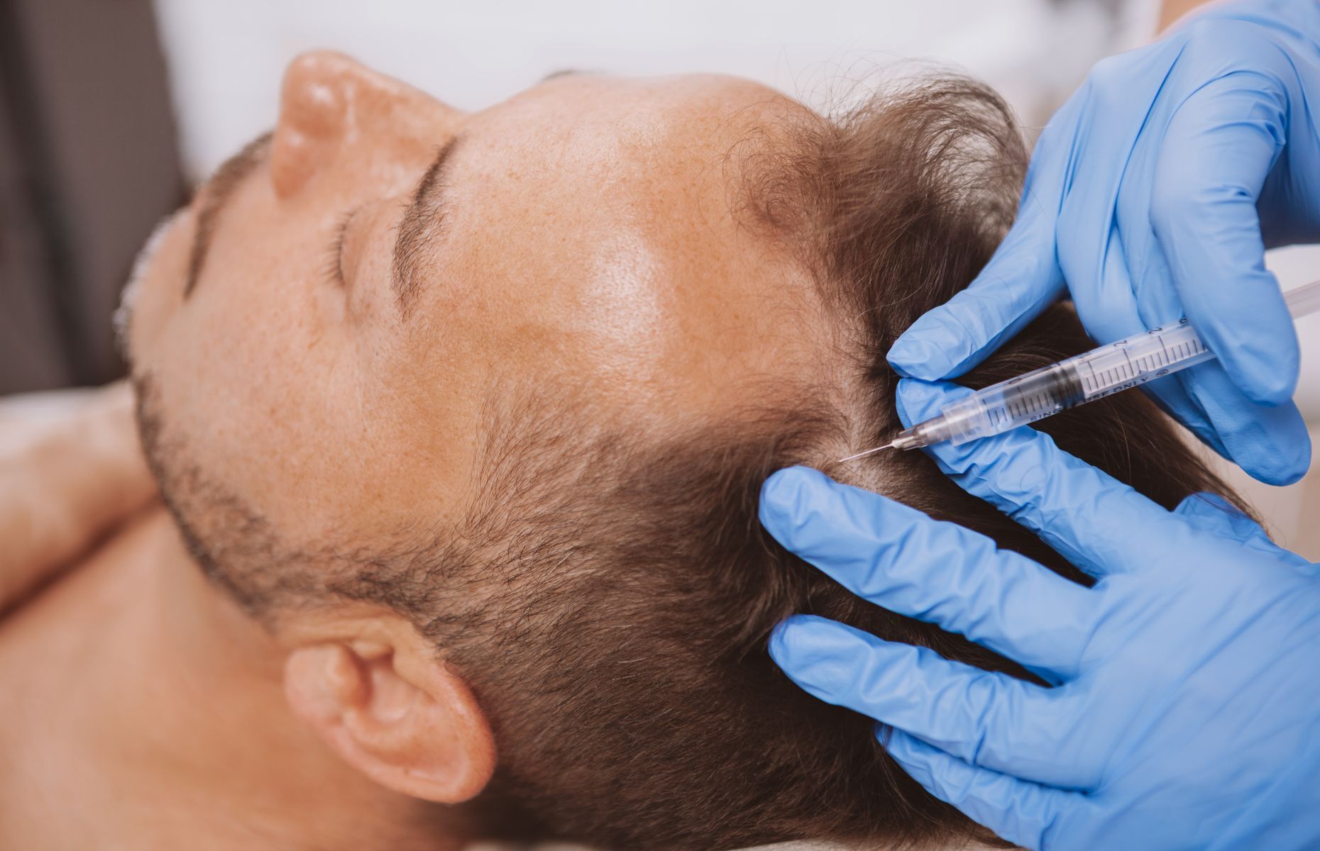 Alopecia Causes, symptoms and treatments