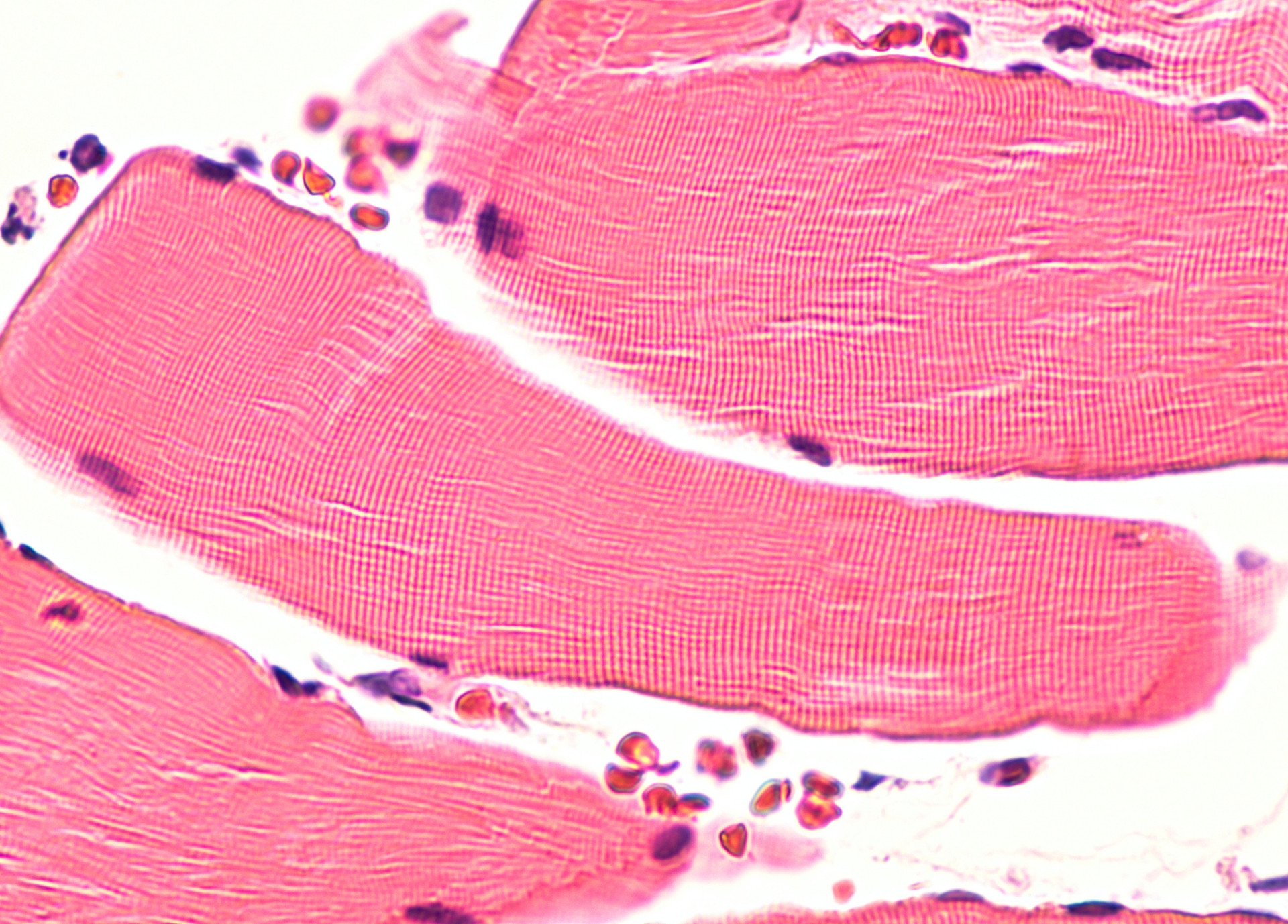 what-exactly-is-malignant-hyperthermia
