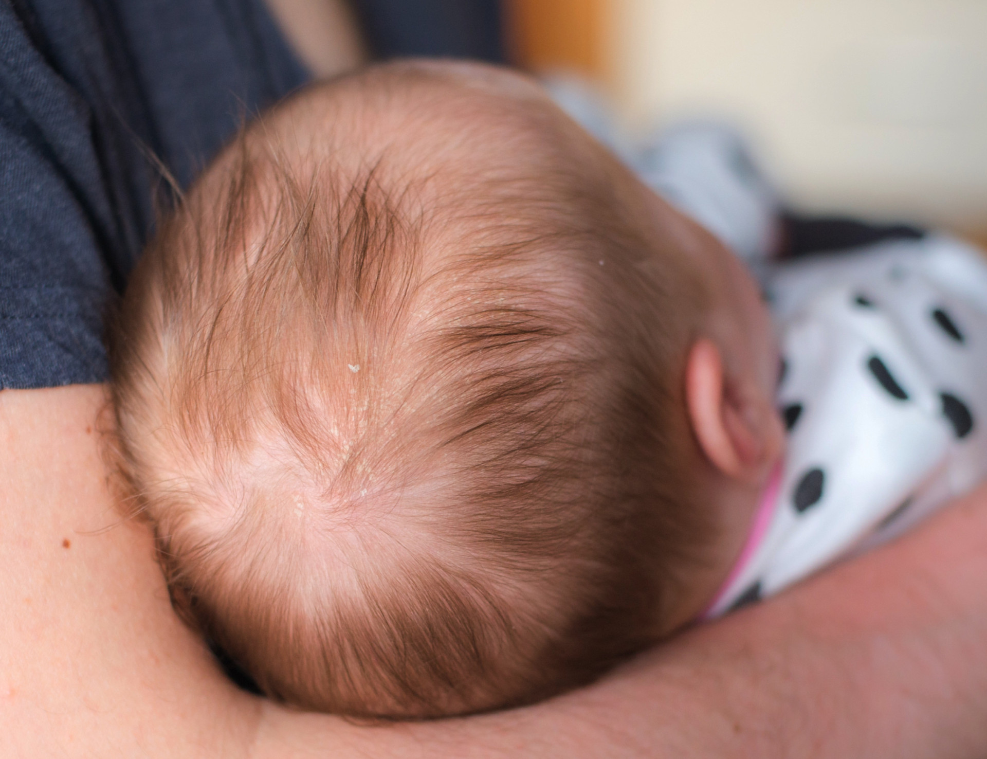 Here's how to really deal with dandruff