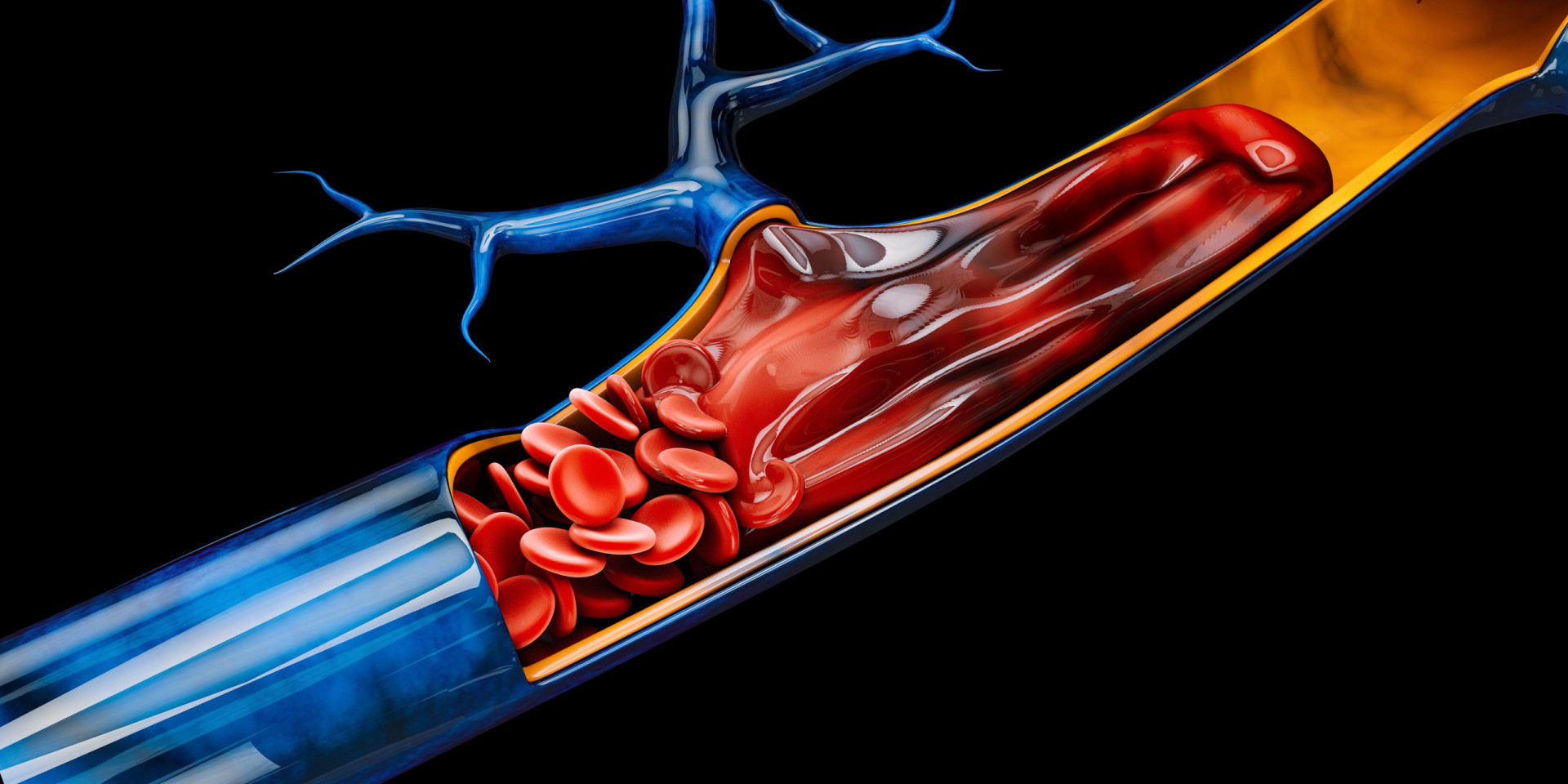 What is deep vein thrombosis, and how can you reduce your risk?