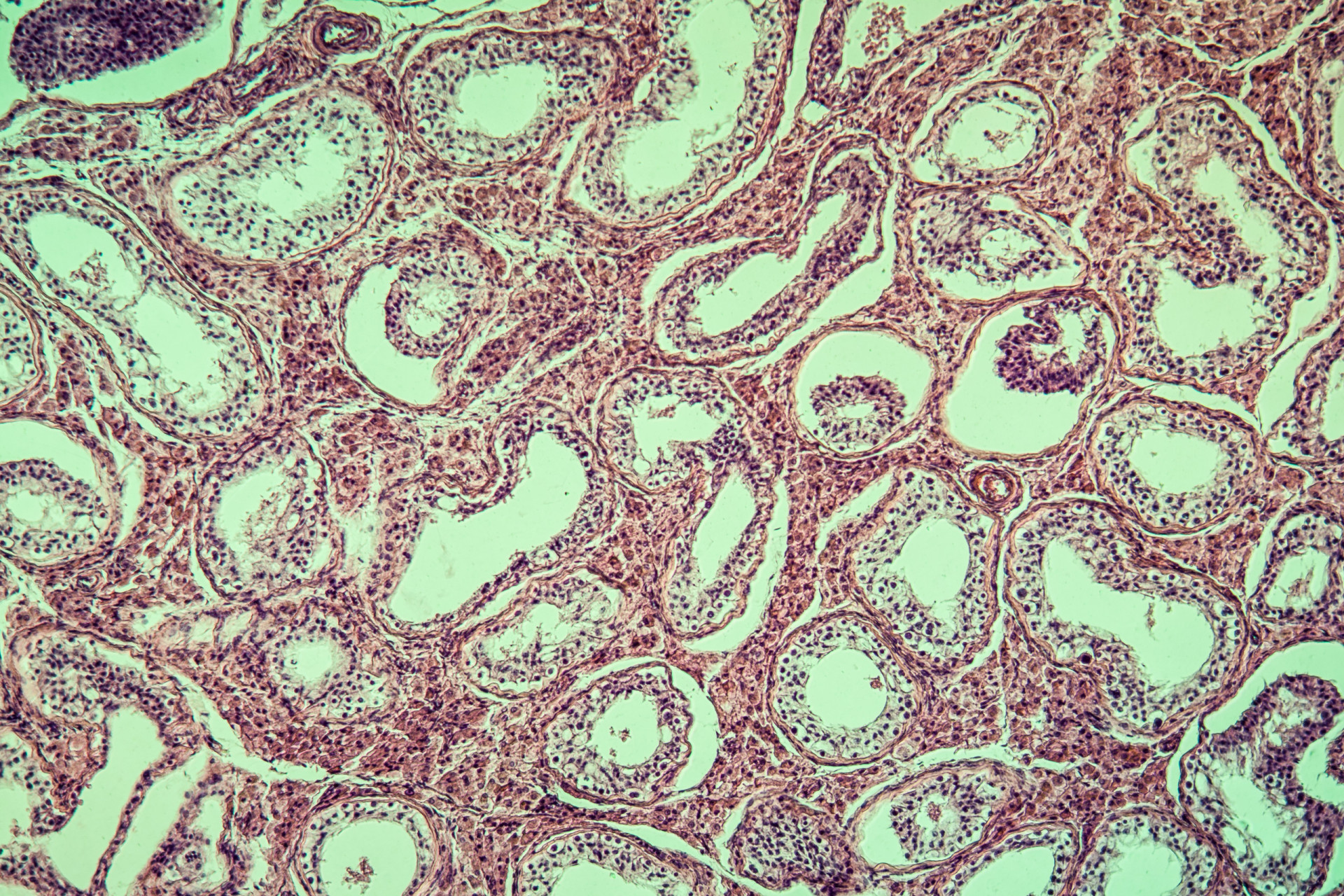Diseased tissue. Diseased tissue. Diseased tissue. Diseased tissue. Ткани пеочкиод микроскопом.