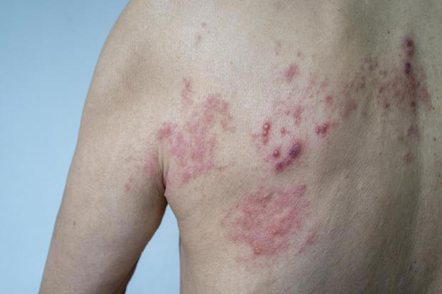 What is shingles? Major questions answered from its cause to if it can ...