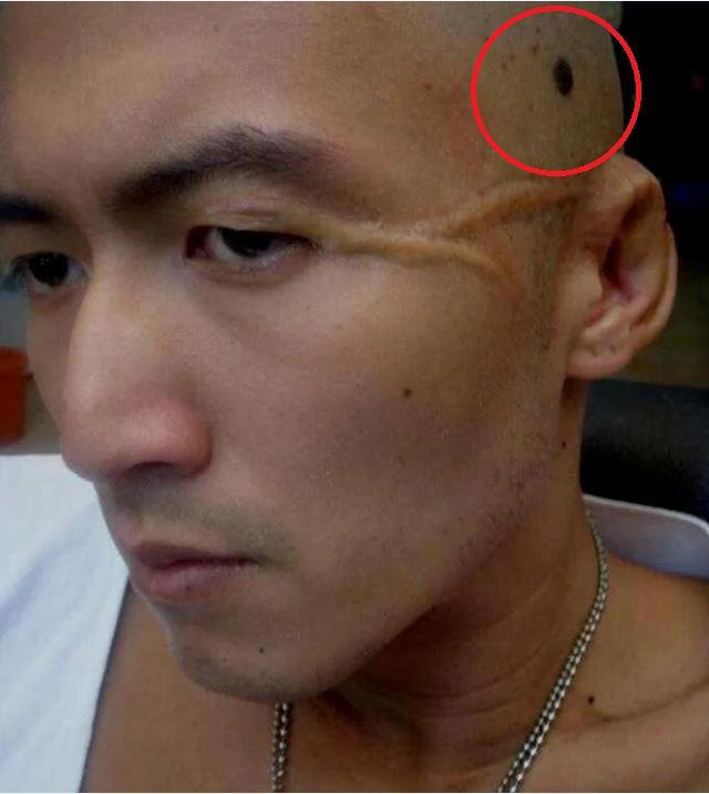謝霆鋒拍《十月圍城》時剪成光頭，意外看到頭上有黑色的色塊就醫診斷是「皮膚癌」。（圖／翻攝自微博）