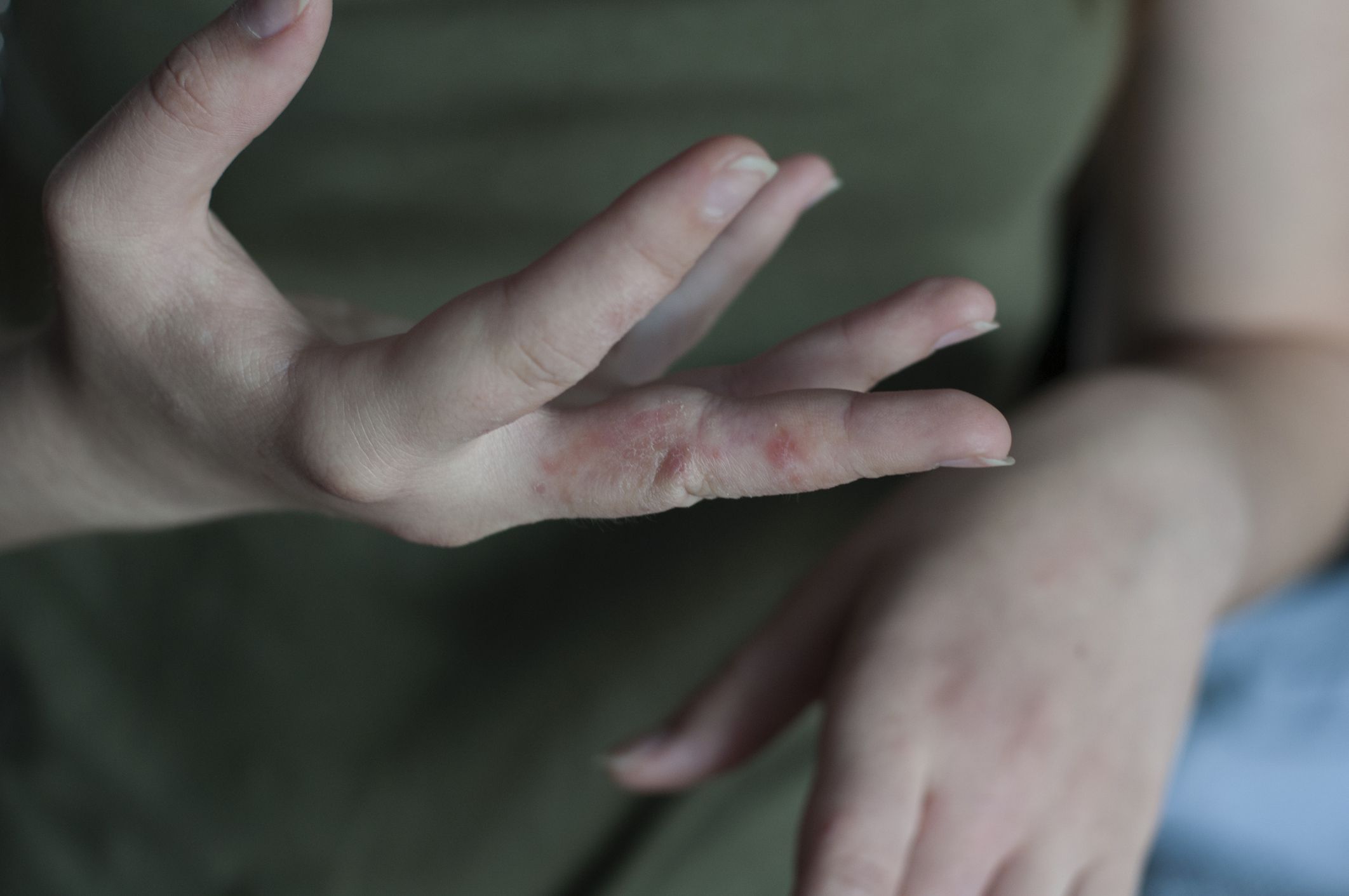 Scabies pictures: What it looks like