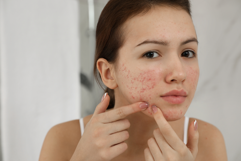 Struggling with acne and flaky scalp? Watch out for these triggers that ...