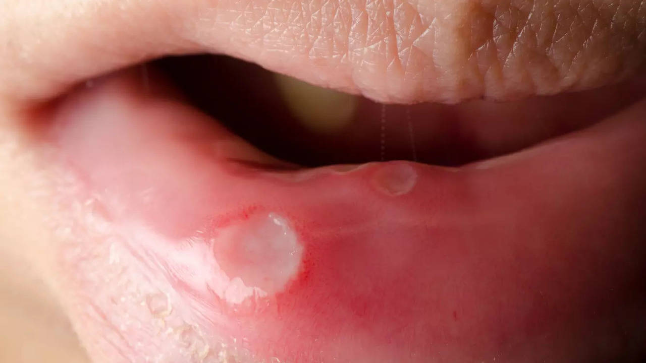 Explained: What cancer in the mouth can feel like