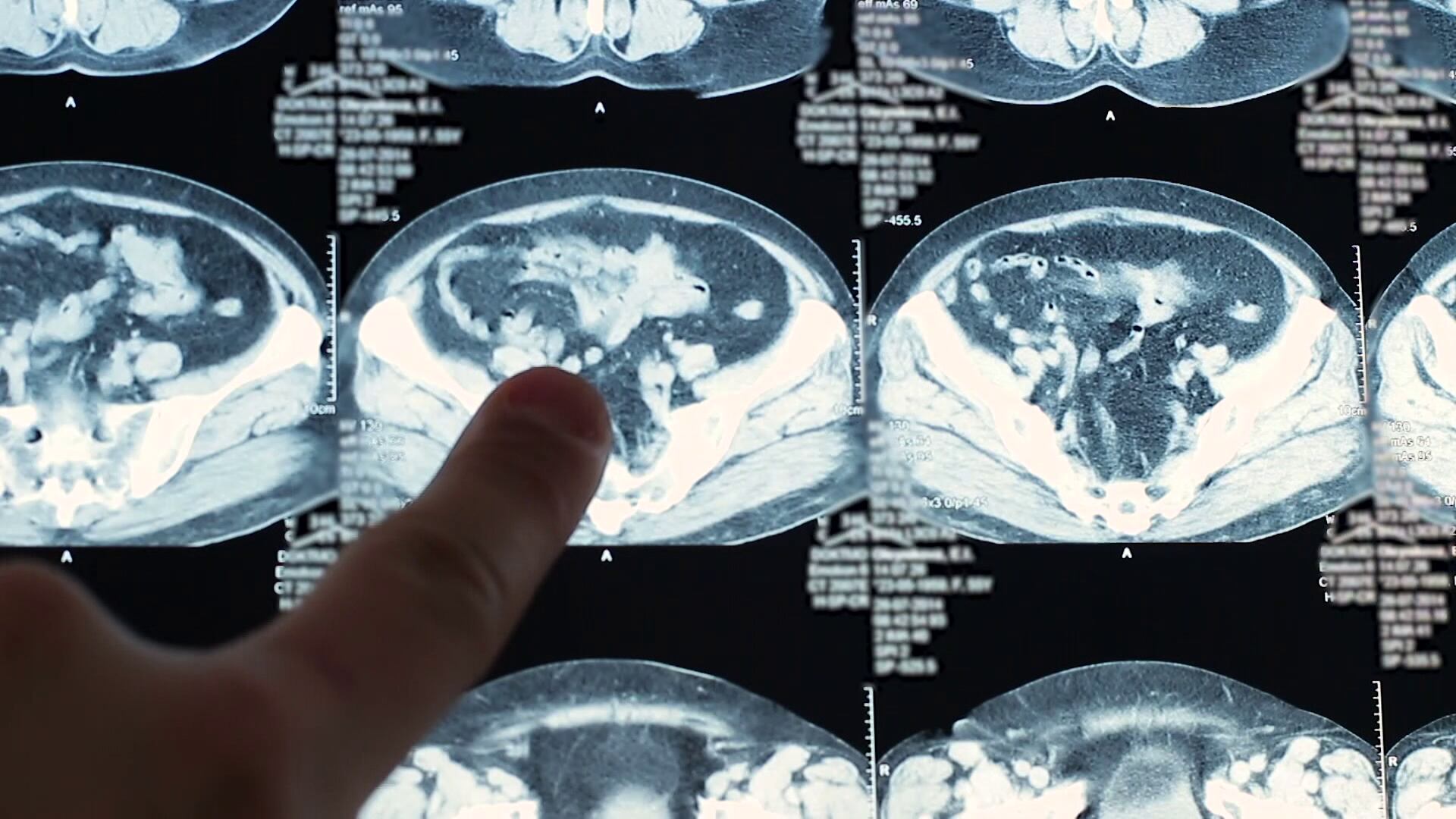 Michigan resident dies after contracting rabies from organ transplant