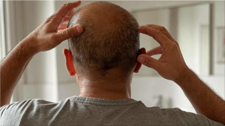 This key protein could help in hair growth, cure baldness, protect follicles