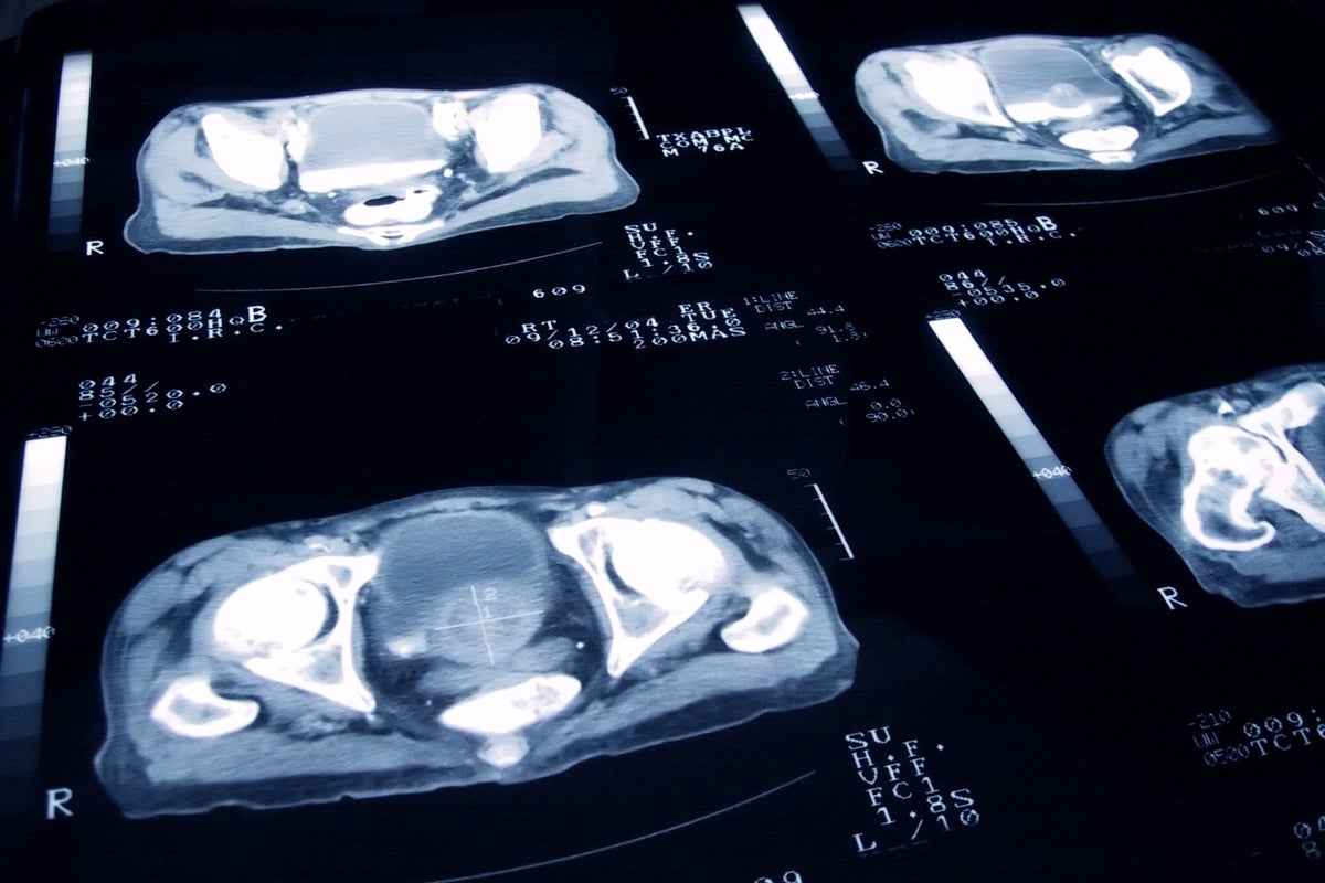 The new test that could predict prostate cancer 15 years in advance