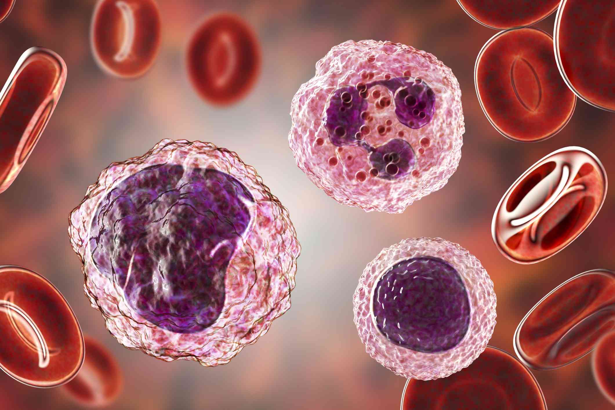 What Do High Neutrophils and Low Lymphocytes Mean?