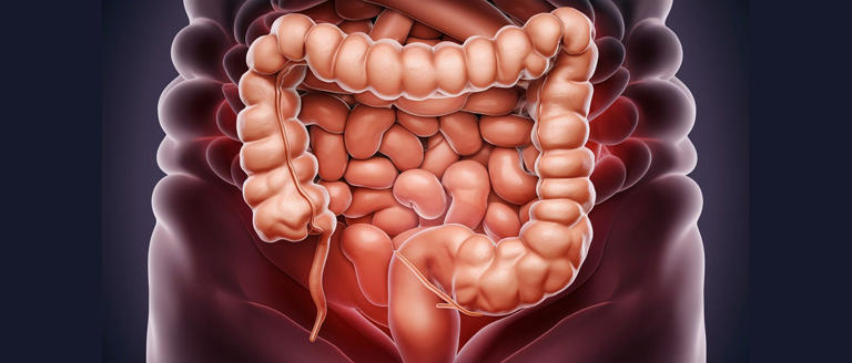 Síntomas de cáncer de colon similares a colon irritable: experto