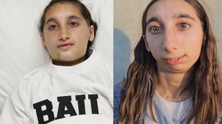 13 yıl ağzını açamadı, 28 kiloya düştü! Türk hekim mucize operasyon