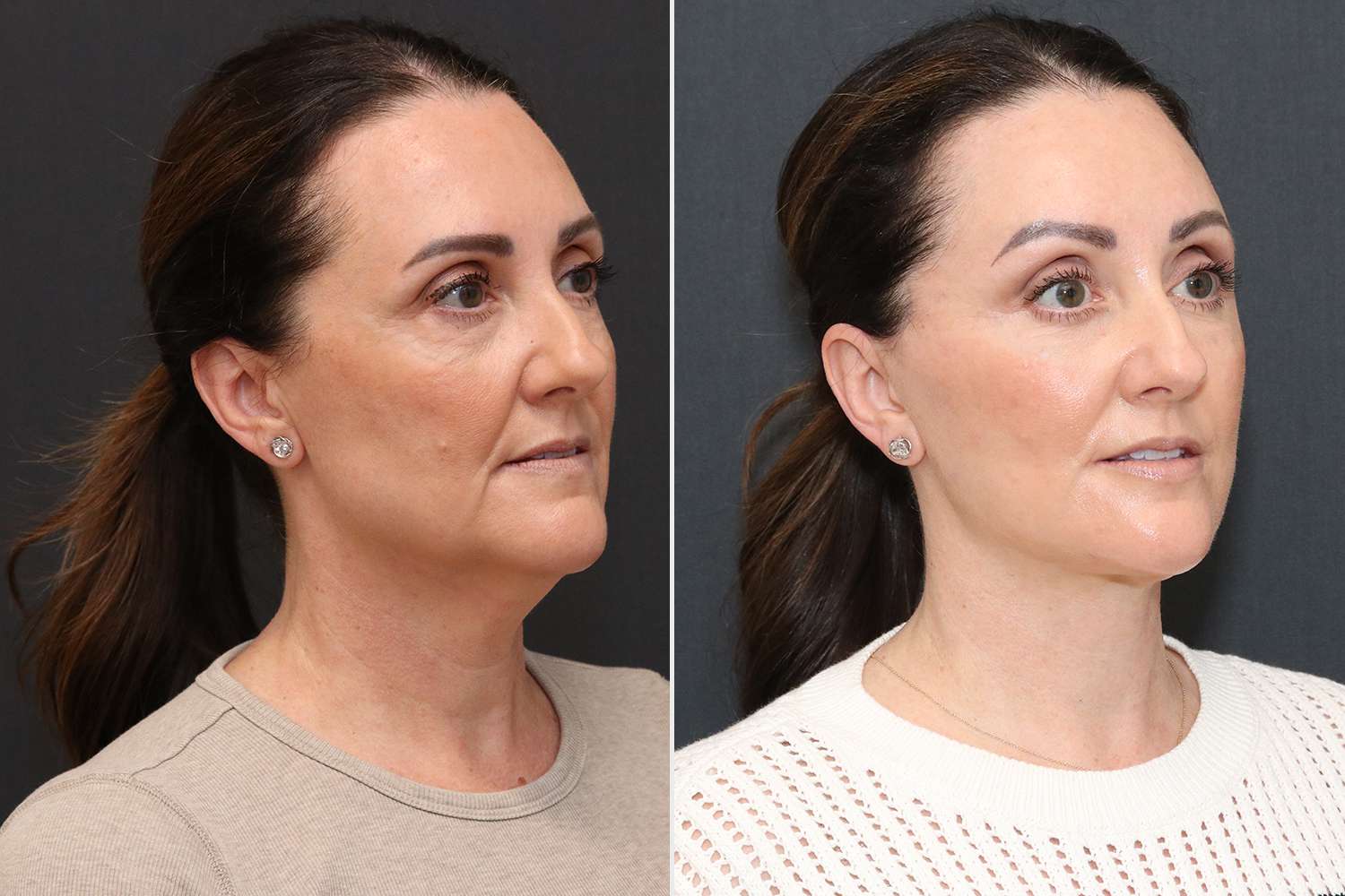 Woman, 52, Wins Free Facelift from Social Media Ad. Her Surgery Was