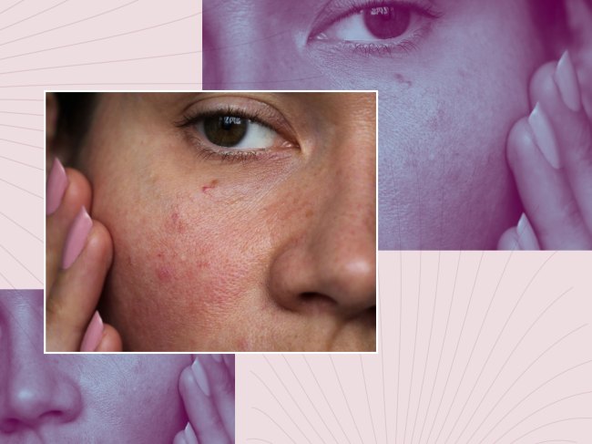 Rosacea, Rashes & Redness: How Menopause May Fuel Skin Sensitivities