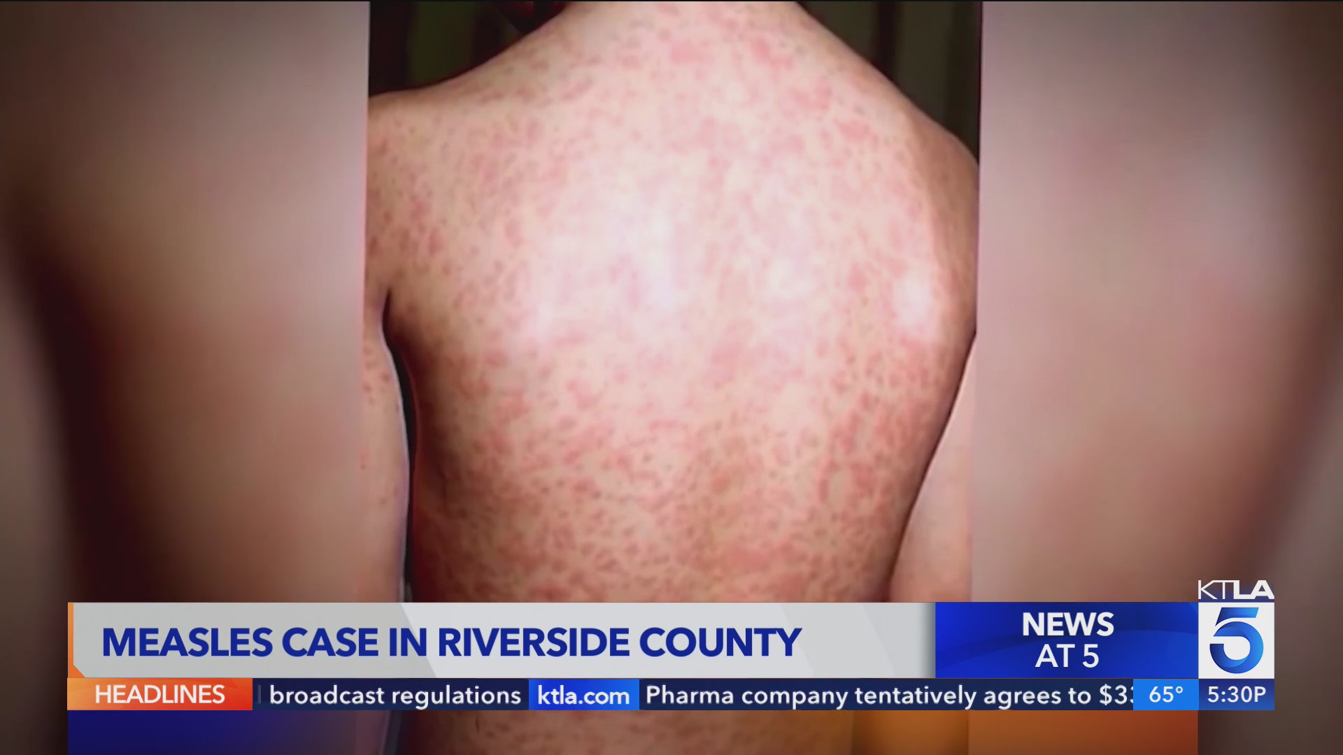 measles-case-in-riverside-county