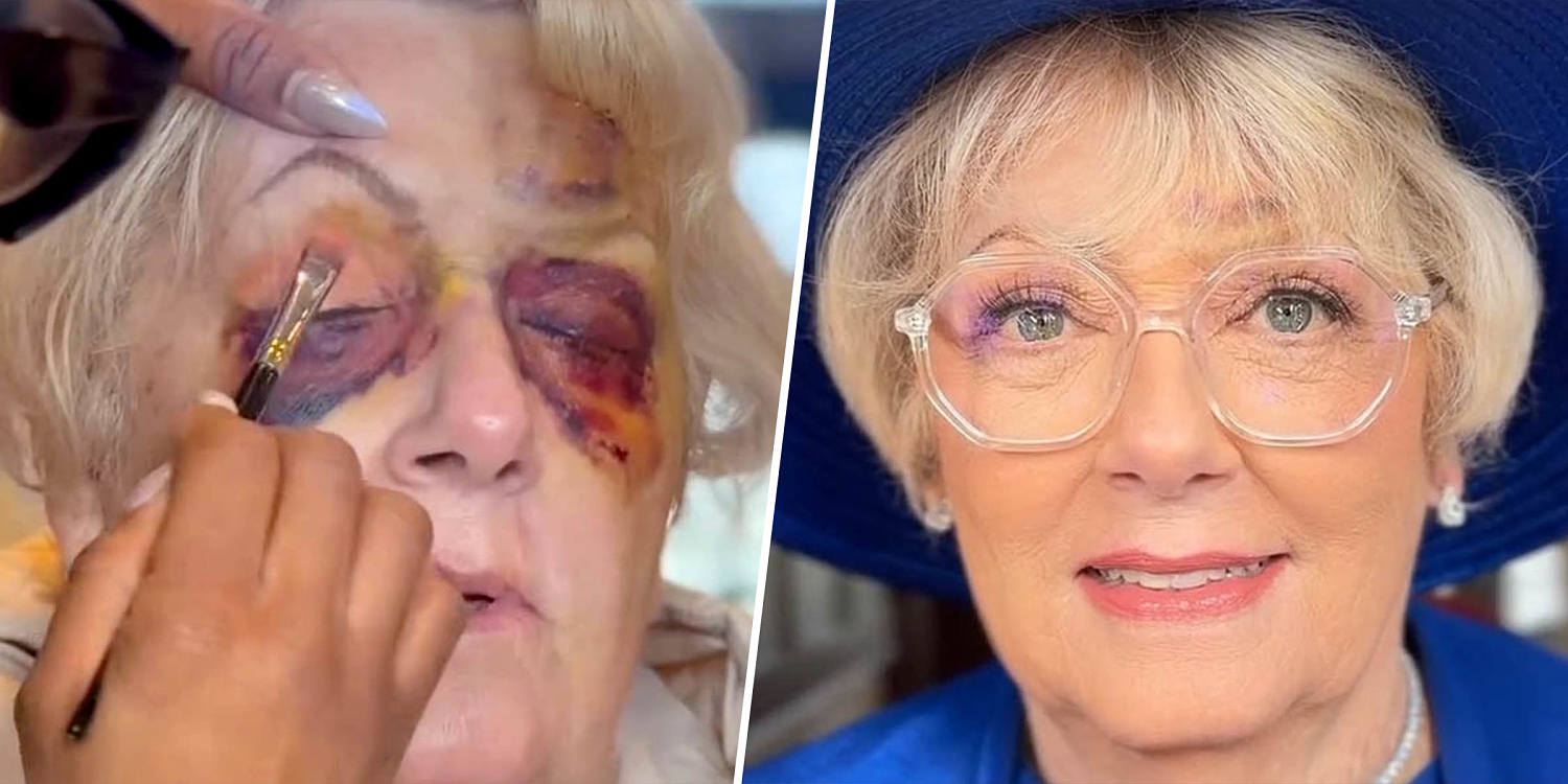 Watch makeup artist transform woman who took 'devastating' fall days