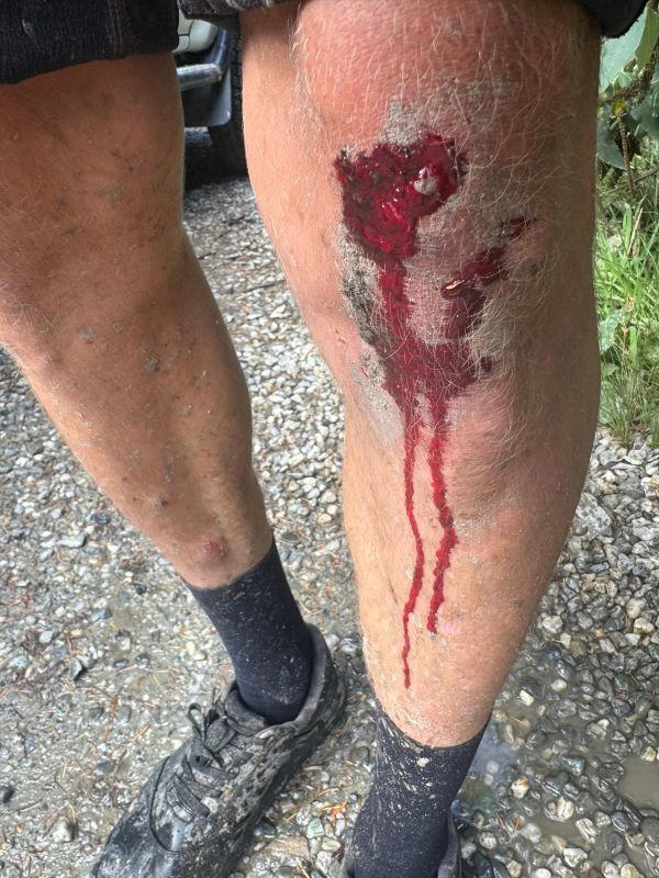 The 5 most common MTB injuries, according to riders who learned the ...