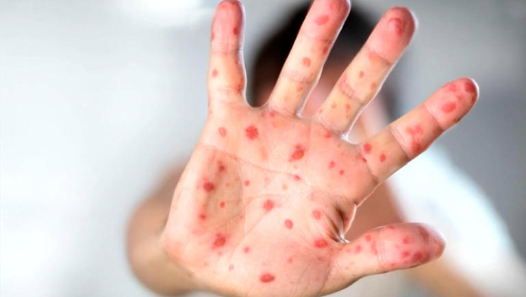 sarampion,Sarampión en Hidalgo,casos de sarampion,Secretaría de Salud de Hidalgo,brote de sarampión Hidalgo,vacuna sarampión