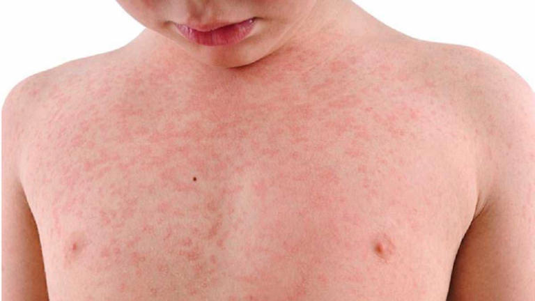 Measles circulating undetected in Aussie city after new case detected
