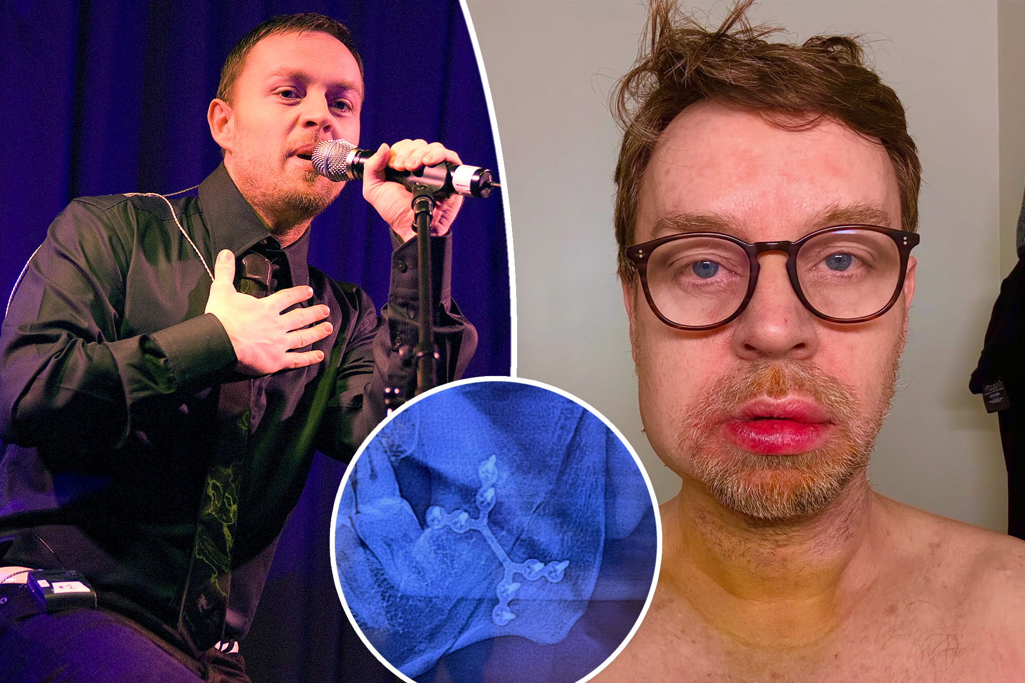 Savage Garden’s Darren Hayes broke his jaw, lost consciousness in