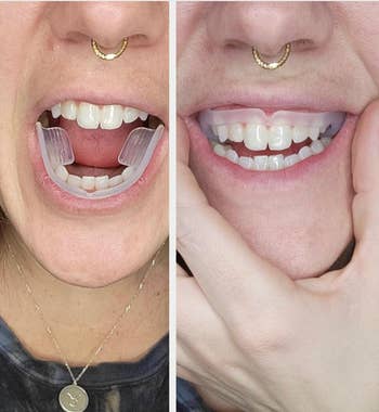 Person demonstrating a dental alignment device in an instructional sequence for improved teeth positioning