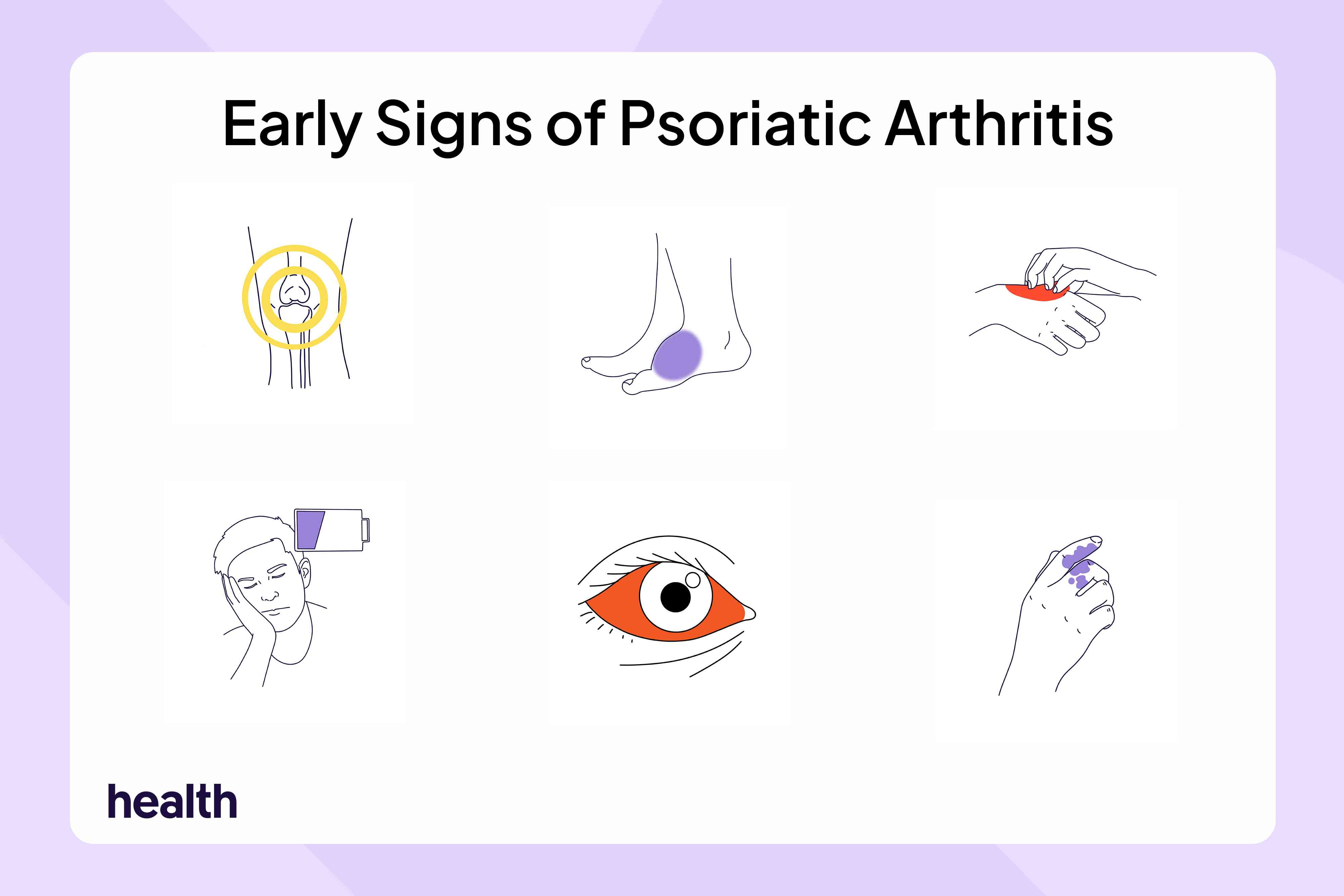 Early Signs and Symptoms of Psoriatic Arthritis (PsA)
