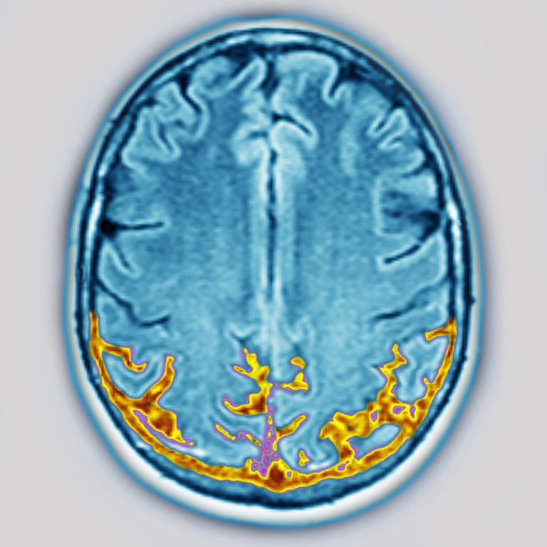 Felnőtteknél alakul ki, látványos tünetei vannak: így ismerd fel az apraxiát