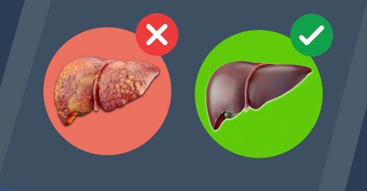 Cáncer de hígado: el primer síntoma que todos ignoran, pero es vital para detectarlo a tiempo